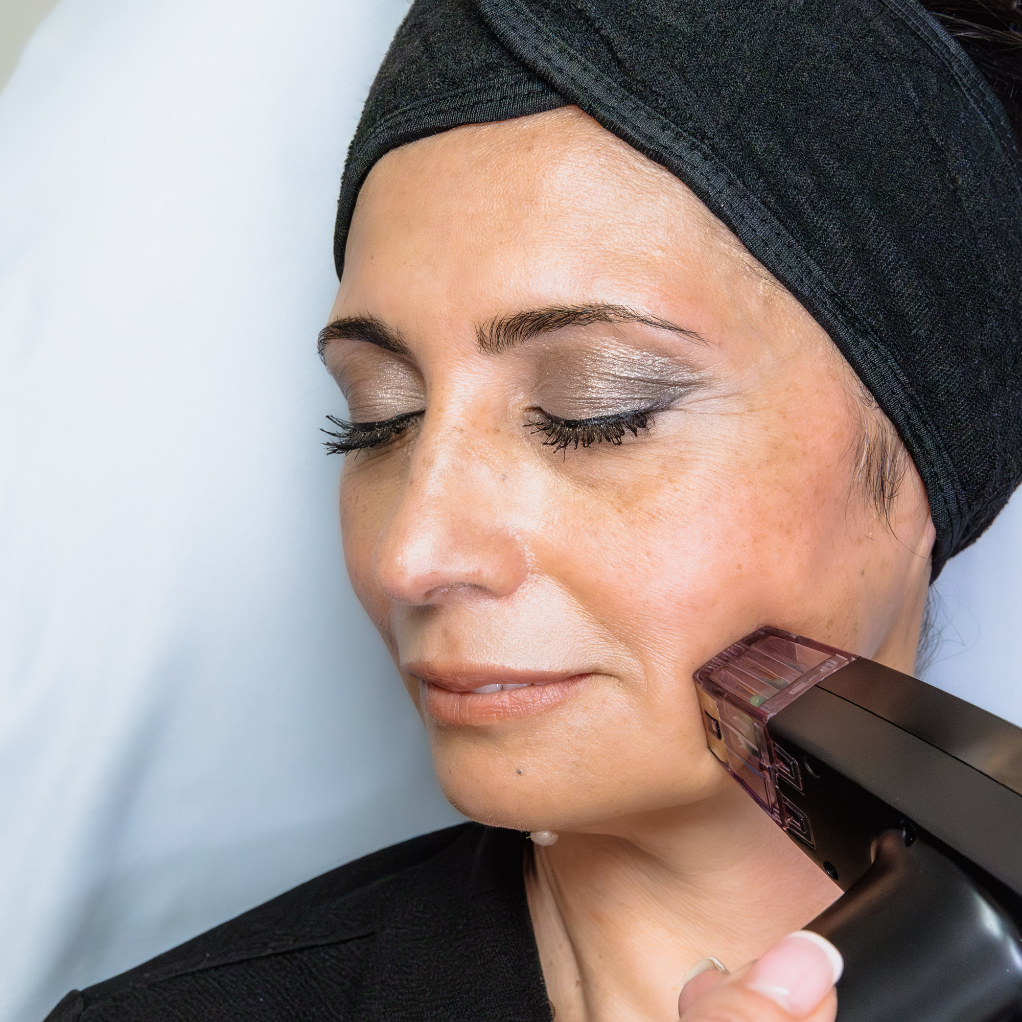RF Microneedling